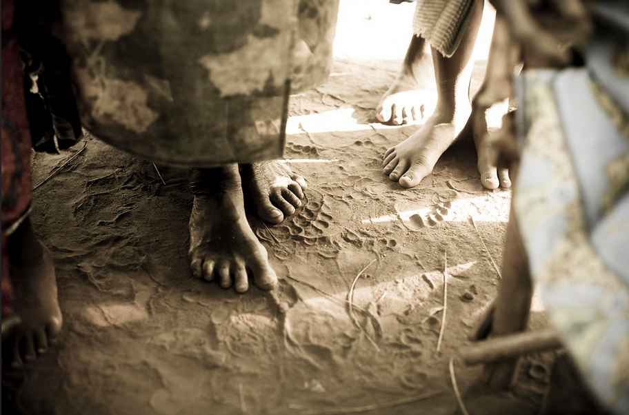 Mycetoma-Ethiopia-A-Tao